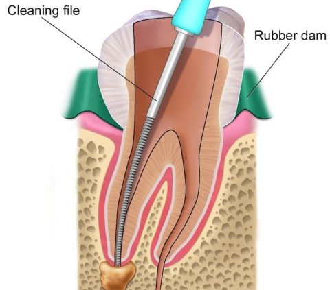 root canal treatment