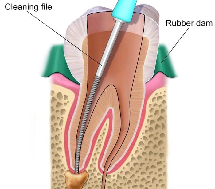 root canal treatment