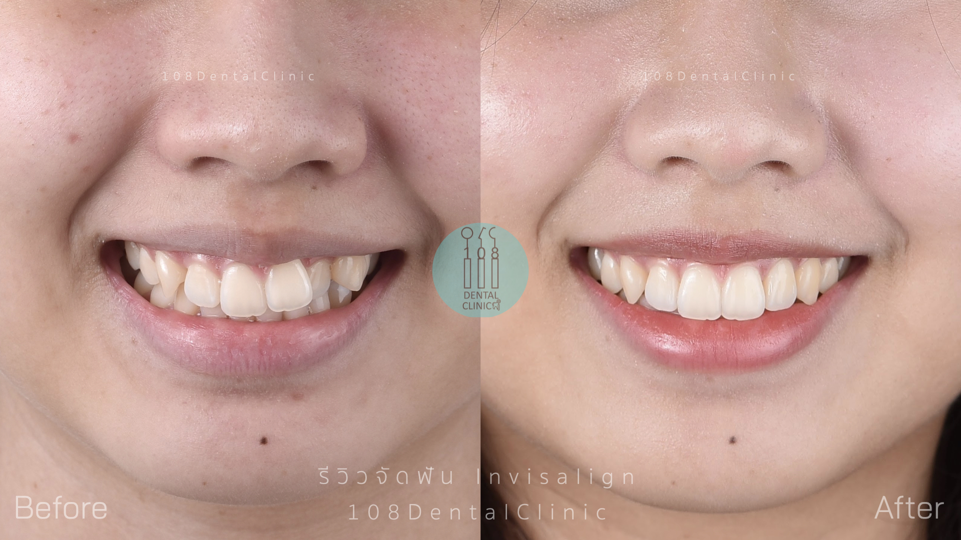 จัดฟัน invisalign รีวิว invisalign