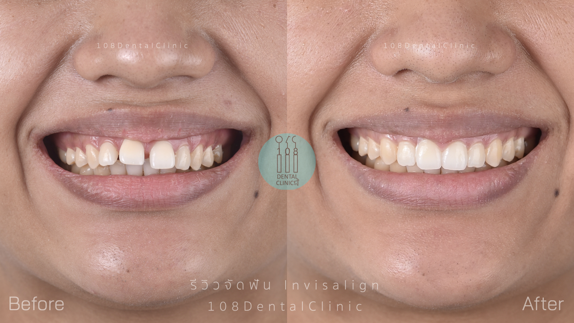 จัดฟัน invisalign รีวิว invisalign