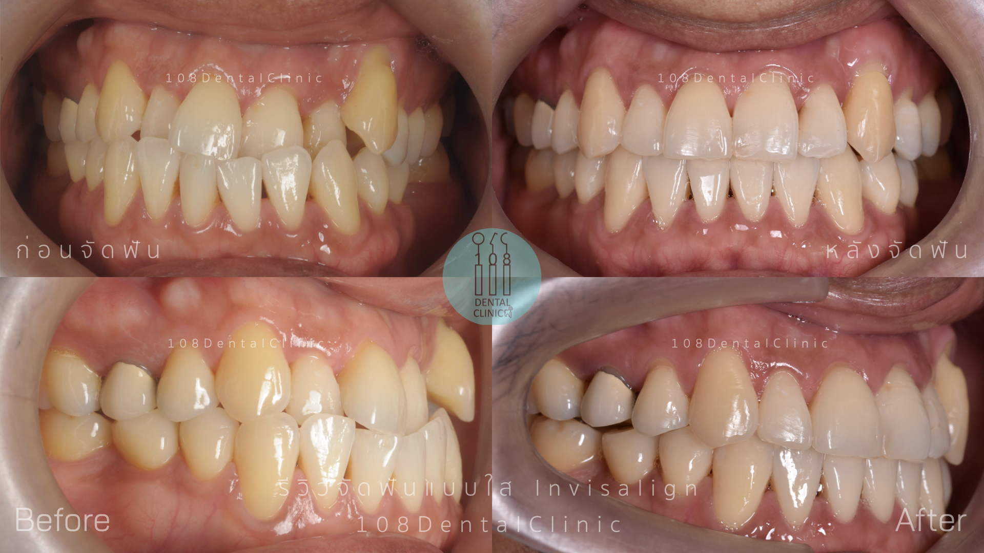 จัดฟัน invisalign รีวิว invisalign