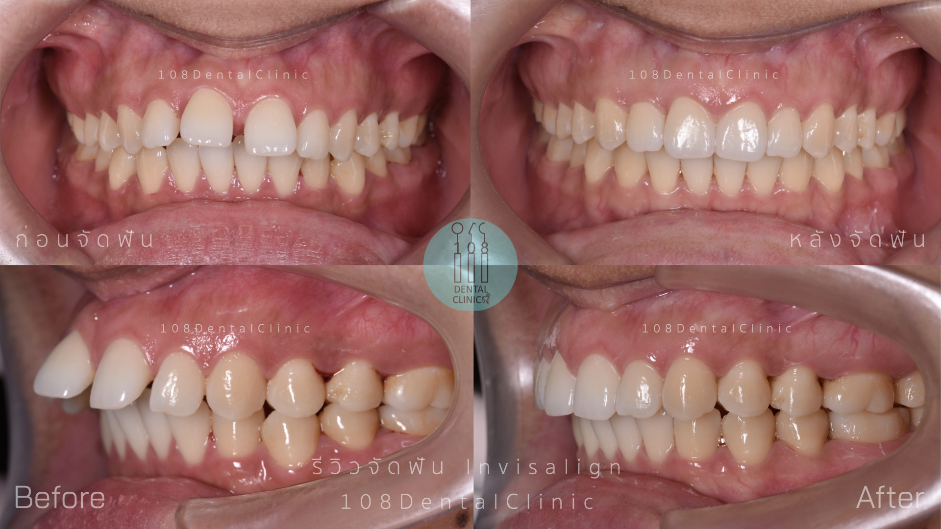 จัดฟัน invisalign รีวิว invisalign