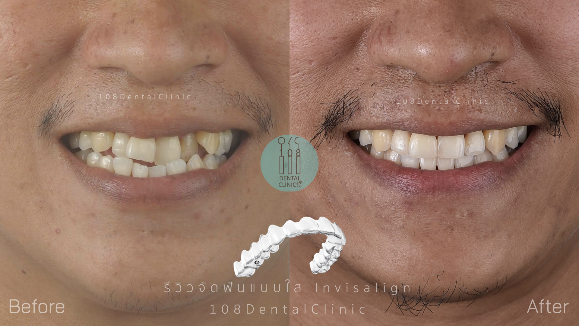 จัดฟัน invisalign รีวิว invisalign